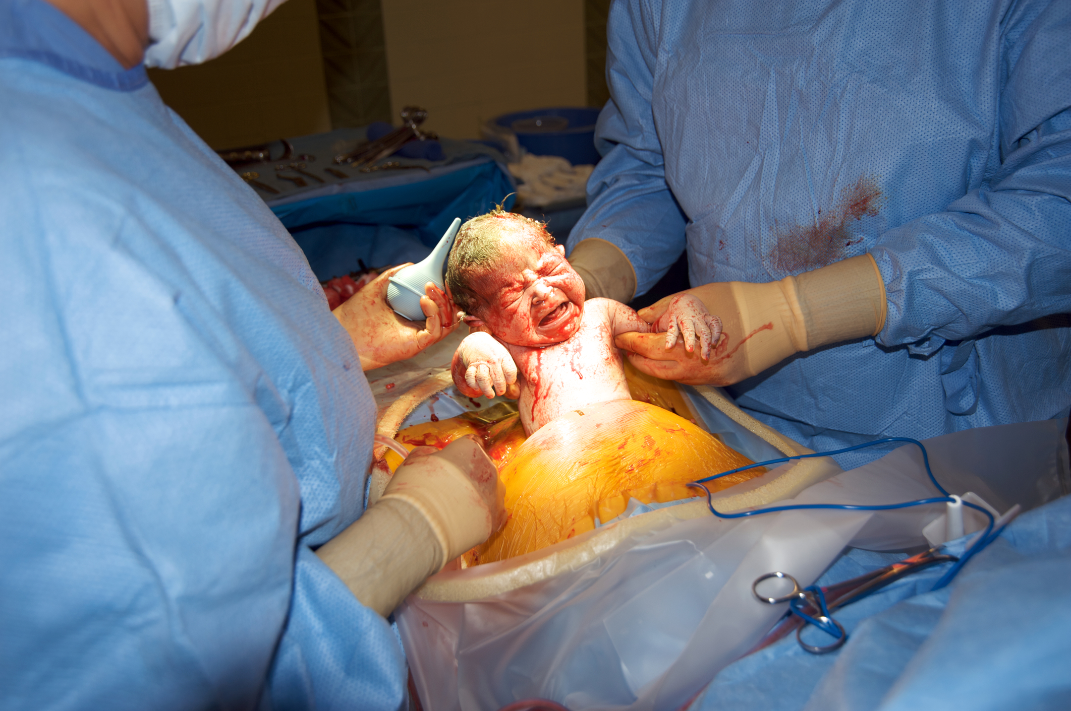 What You Can Do to Avoid a Cesarean